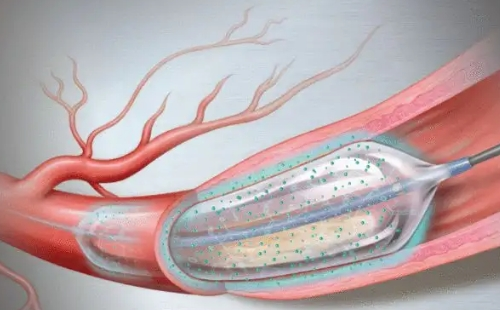 冠脈擴(kuò)張球囊是什么_價格多少錢